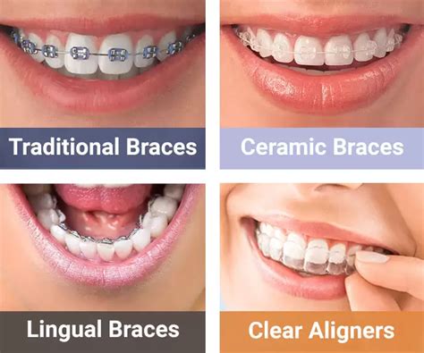 metal and ceramic brackets|ceramic braces cost per month.